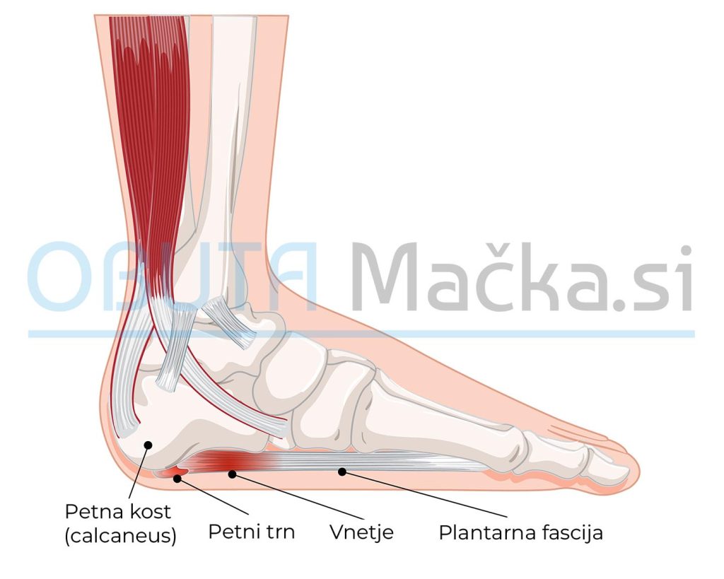 Petni trn in plantarna fascija