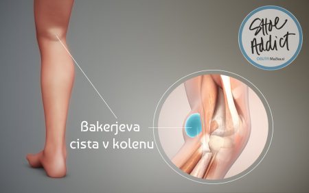 Bakerjeva cista: vse, kar morate vedeti